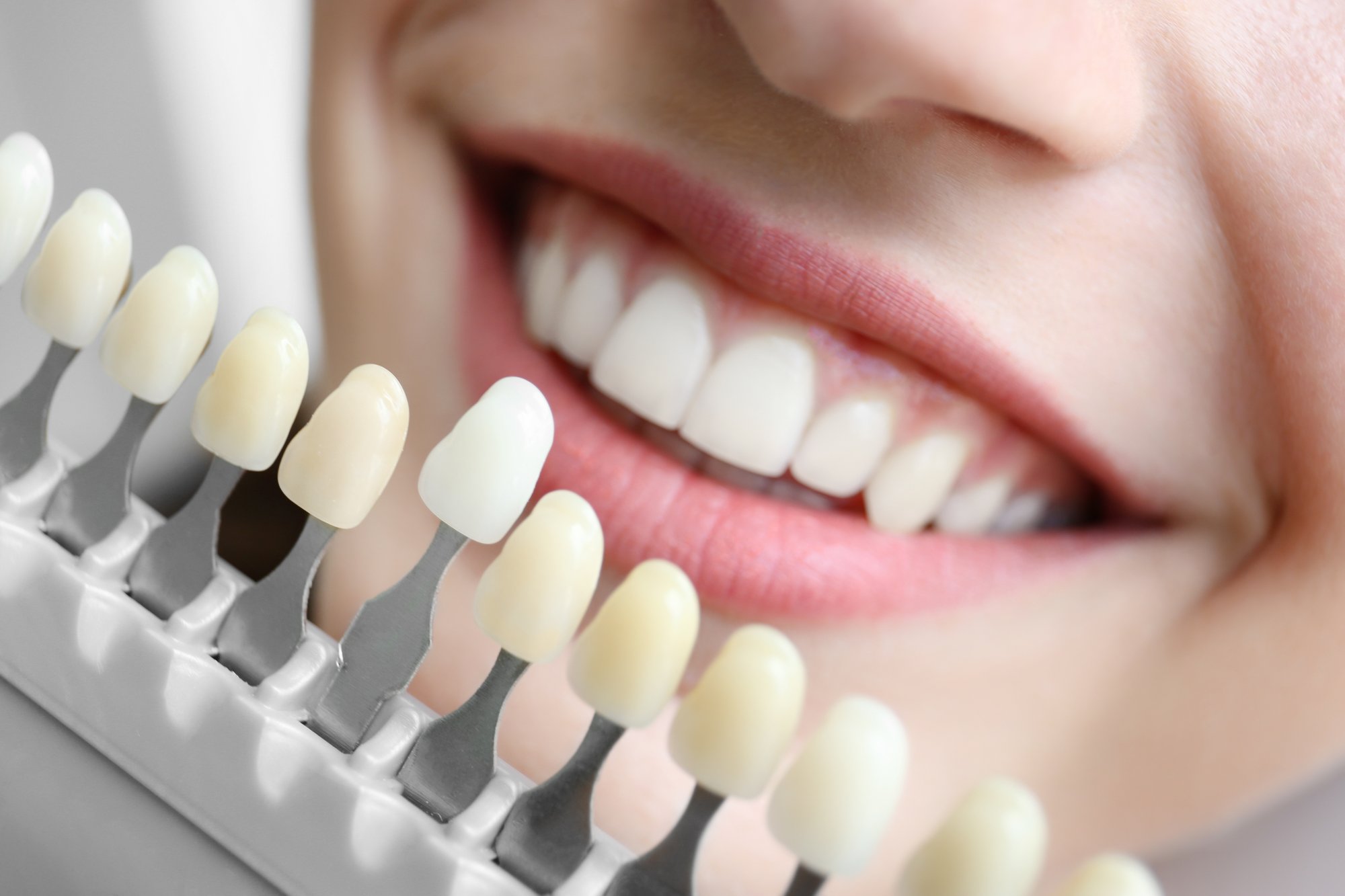 Will Whitening Make My Sensitive Teeth Hurt?